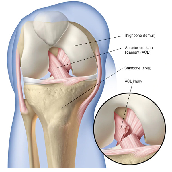 ACL-injury ACL injury