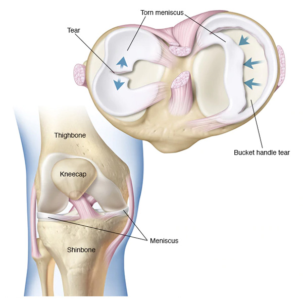 Torn-meniscus Torn meniscus