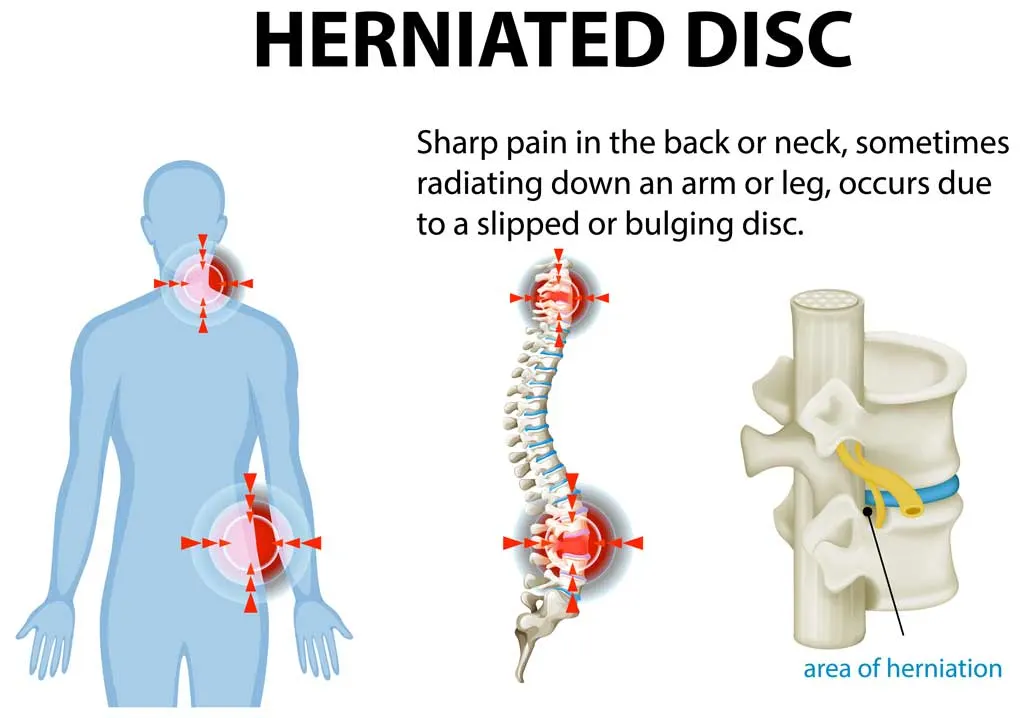 Fascial-Manipulation-for-Degenerative-Disc-Disease Fascial Manipulation for DDD